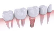 A solução para recuperar dentes perdidos: Implantes Dentários