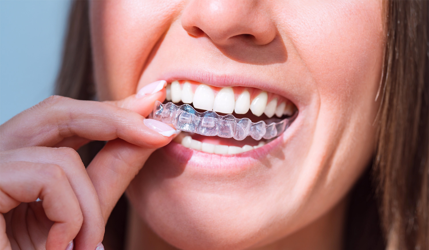 Alinhadores Invis&iacute;veis ou Aparelho Dent&aacute;rio: Qual a Melhor Op&ccedil;&atilde;o para Corrigir o Seu Sorriso?