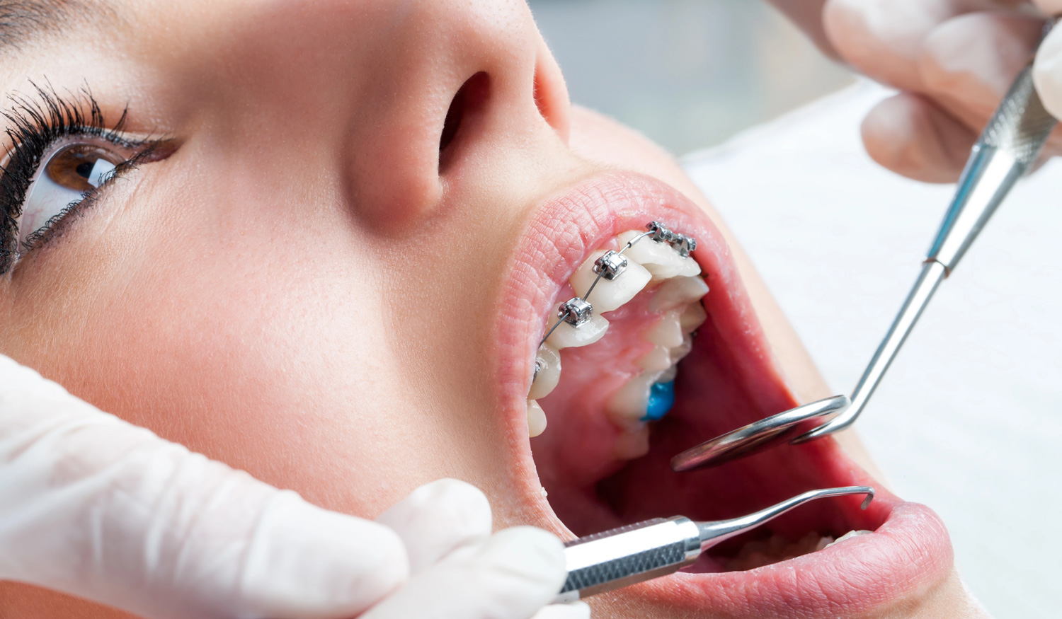 Aparelhos Autoligados e Aparelhos Tradicionais: Qual &eacute; a Diferen&ccedil;a?