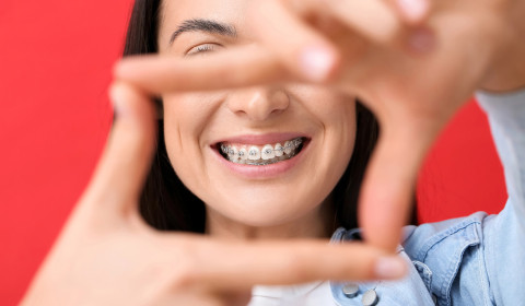 Aparelhos Dentários: Que tipos existem e qual o melhor?