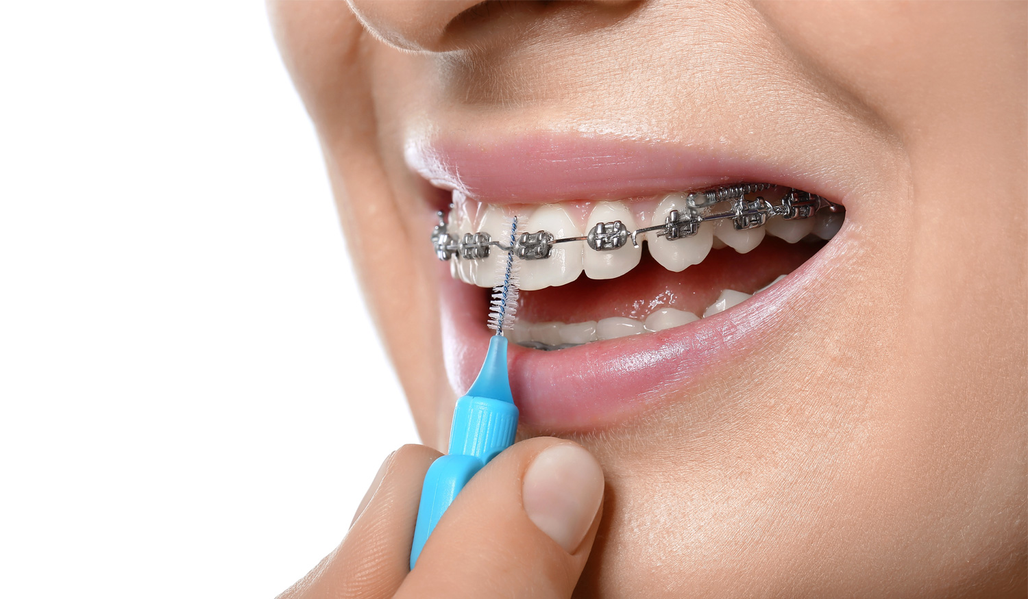 Como lavar os dentes com aparelho dent&aacute;rio fixo?