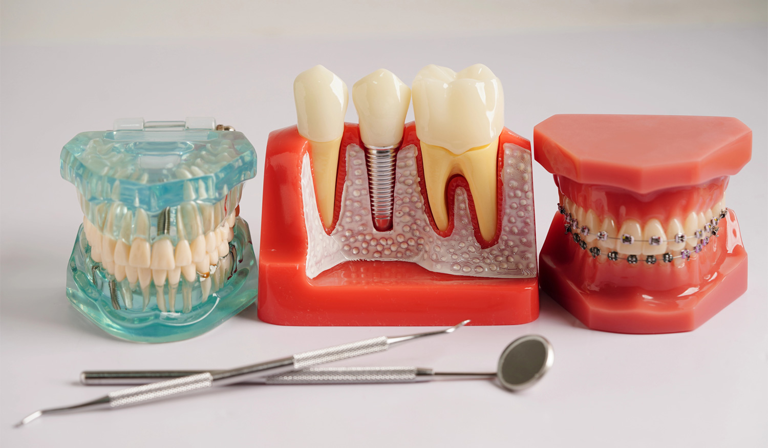 O que (ainda) não sabe sobre Implantes Dentários