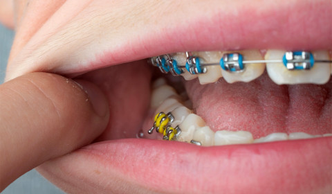 O seu filho precisa de aparelho dentário?