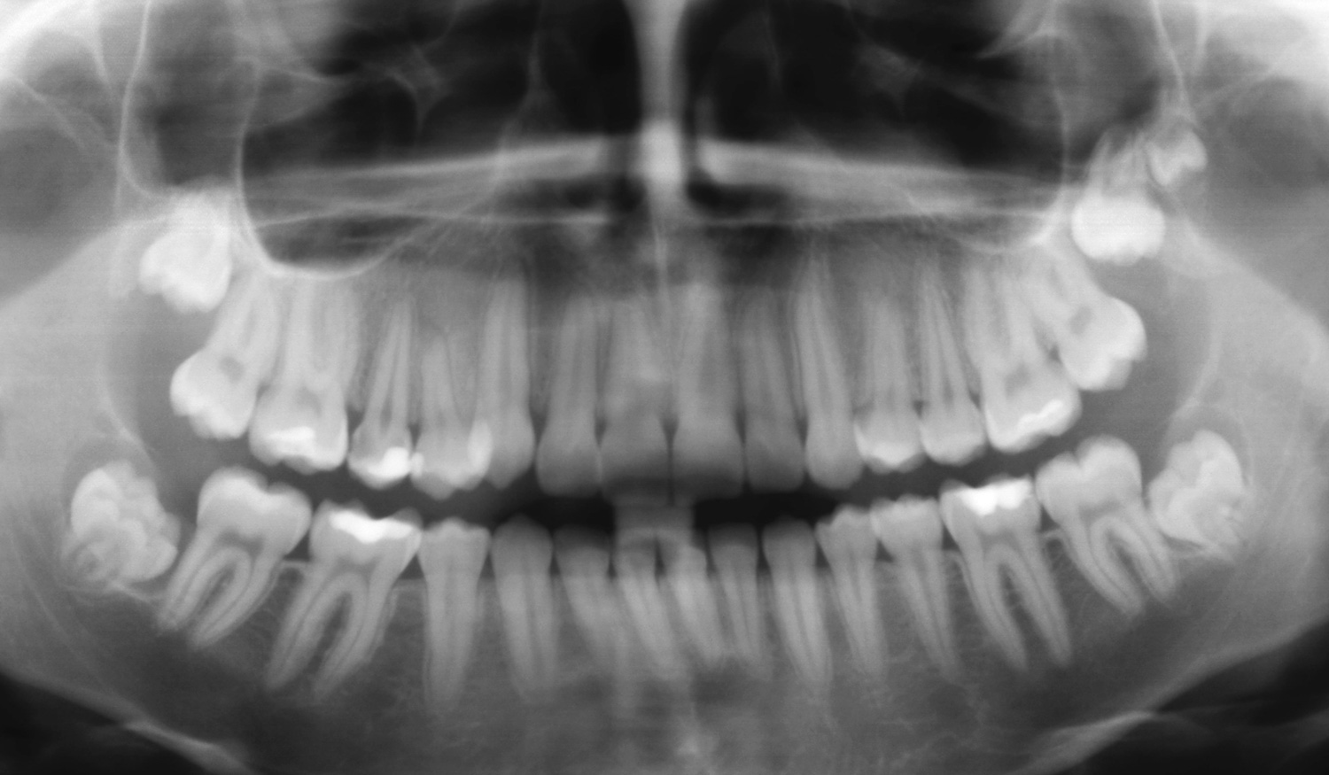 Tudo o que precisa de saber sobre Dentes do Siso