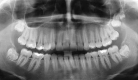 Tudo o que precisa de saber sobre Dentes do Siso