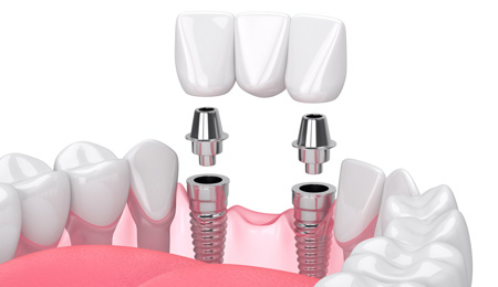 slide-implantes-dentarios.jpg